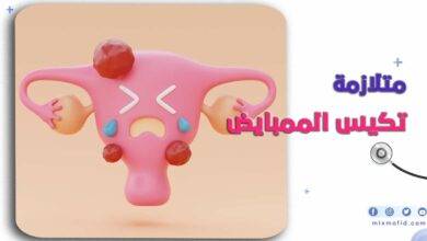 متلازمة تكيس المبايض