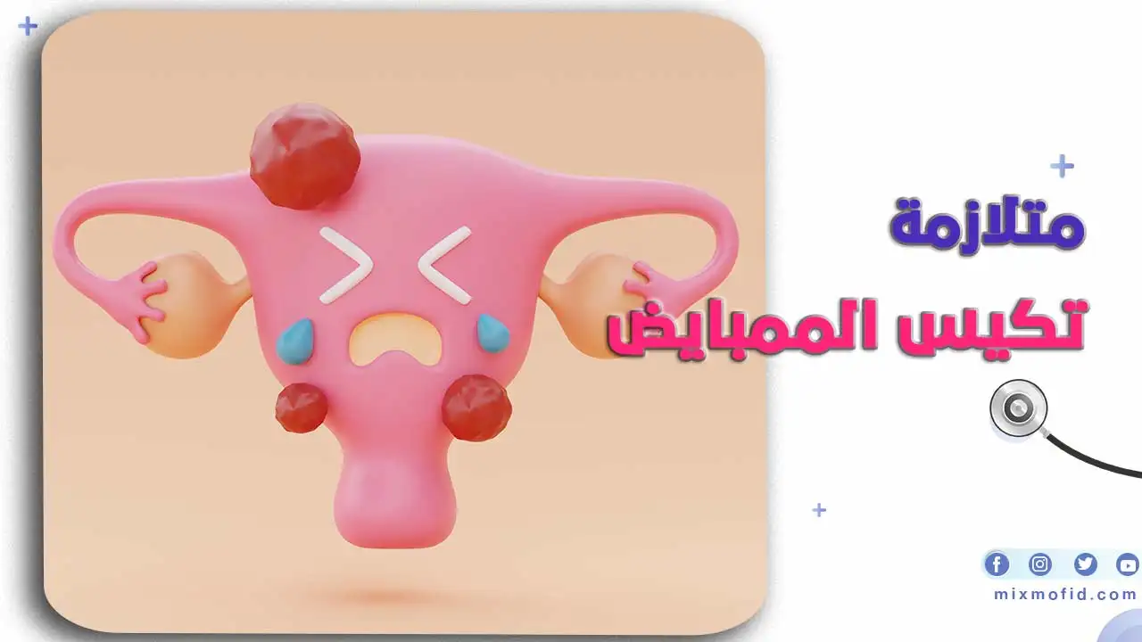 متلازمة تكيس المبايض